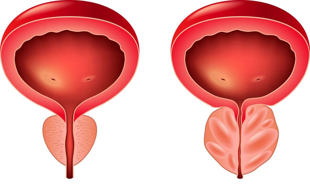 normalna i chora prostata